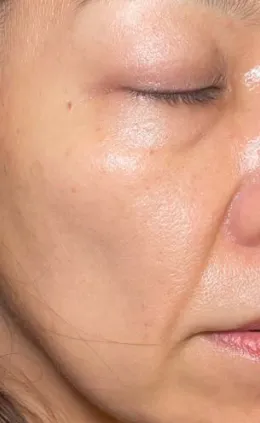 施術後
